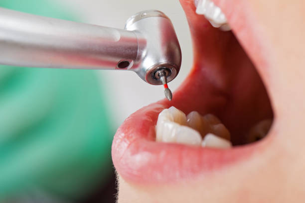 Best Emergency Dental Care for Abscessed Tooth in New Miami, OH